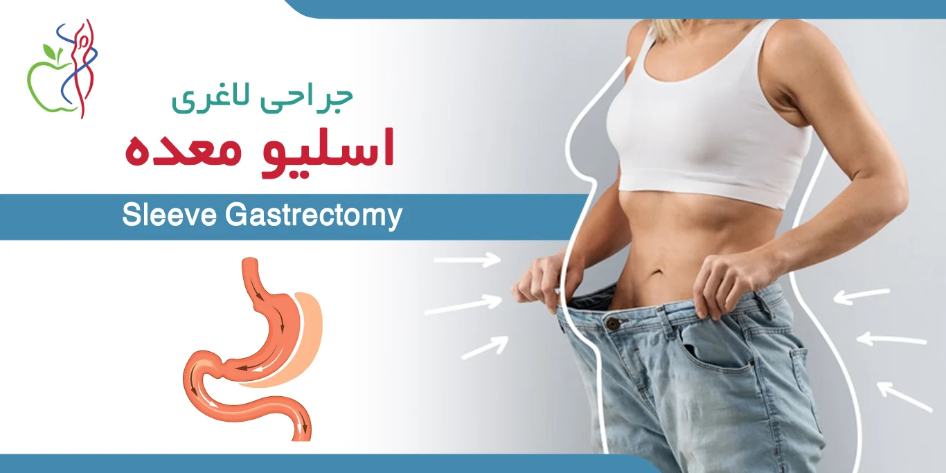 عمل اسلیو معده