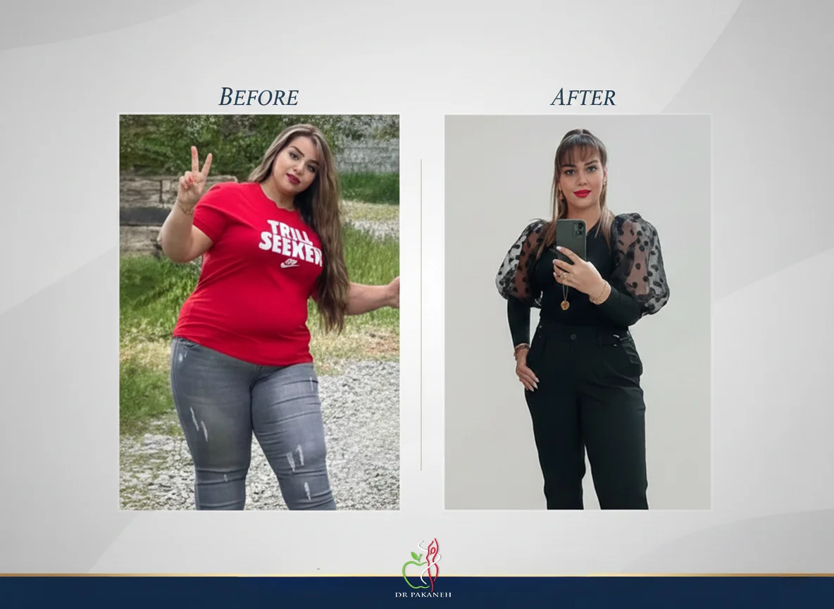 شاخص توده بدنی (BMI) مناسب عمل اسلیو، بای پس و مینی‌بای پس معده
